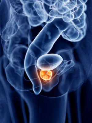 Cáncer de próstata: una conversación necesaria en Colombia