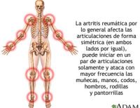 Mamás colombianas, en riesgo de padecer Artritis Reumatoide