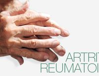 Más allá de la artritis