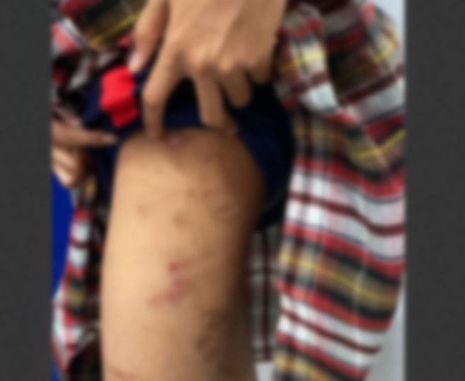 Alerta en Buenaventura: Menor adoptada es víctima de presunto maltrato