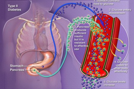 Nuevas opciones de tratamiento para la diabetes tipo II en Colombia