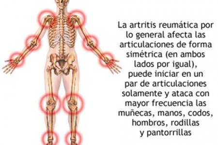 Mamás colombianas, en riesgo de padecer Artritis Reumatoide