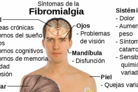 Fibromialgia, un reto para la medicina en Colombia