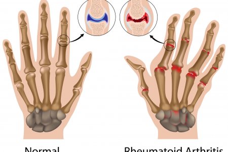 Artritis reumatoide, una enfermedad que afecta la calidad de vida más de lo que usted imagina