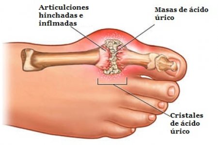 Altos niveles de ácido úrico en la sangre pueden ocasionar graves problemas al organismo