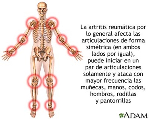 Mamás colombianas, en riesgo de padecer Artritis Reumatoide