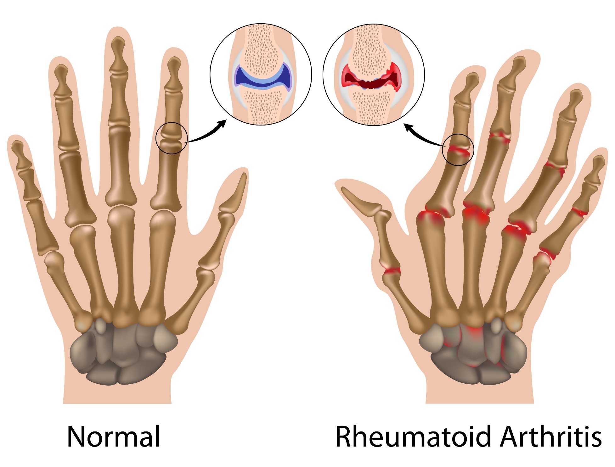 Artritis reumatoide, una enfermedad que afecta la calidad de vida más de lo que usted imagina