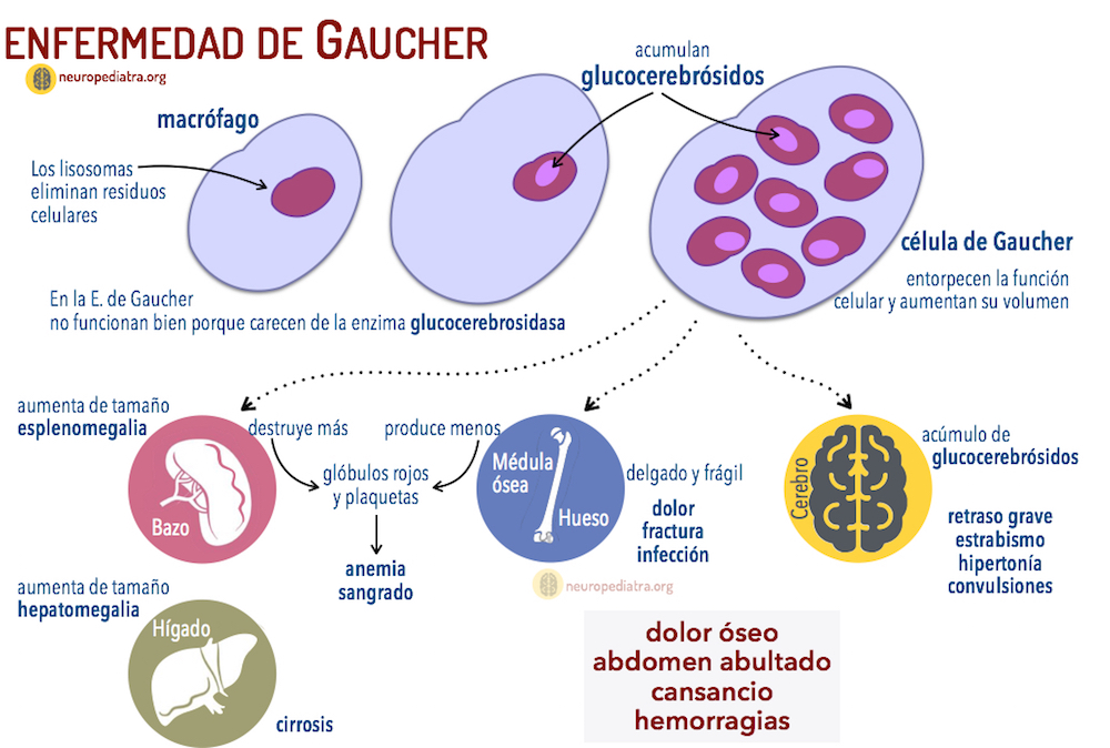 Enfermedad de Gaucher: una patología rara que deteriora notablemente la calidad de vida