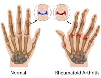 Artritis reumatoide, una enfermedad que afecta la calidad de vida más de lo que usted imagina